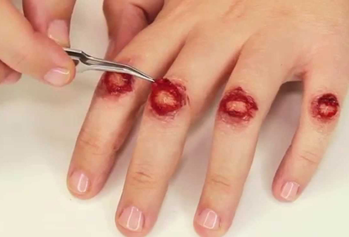 Cleaning and treating open wounds with Essential Oils