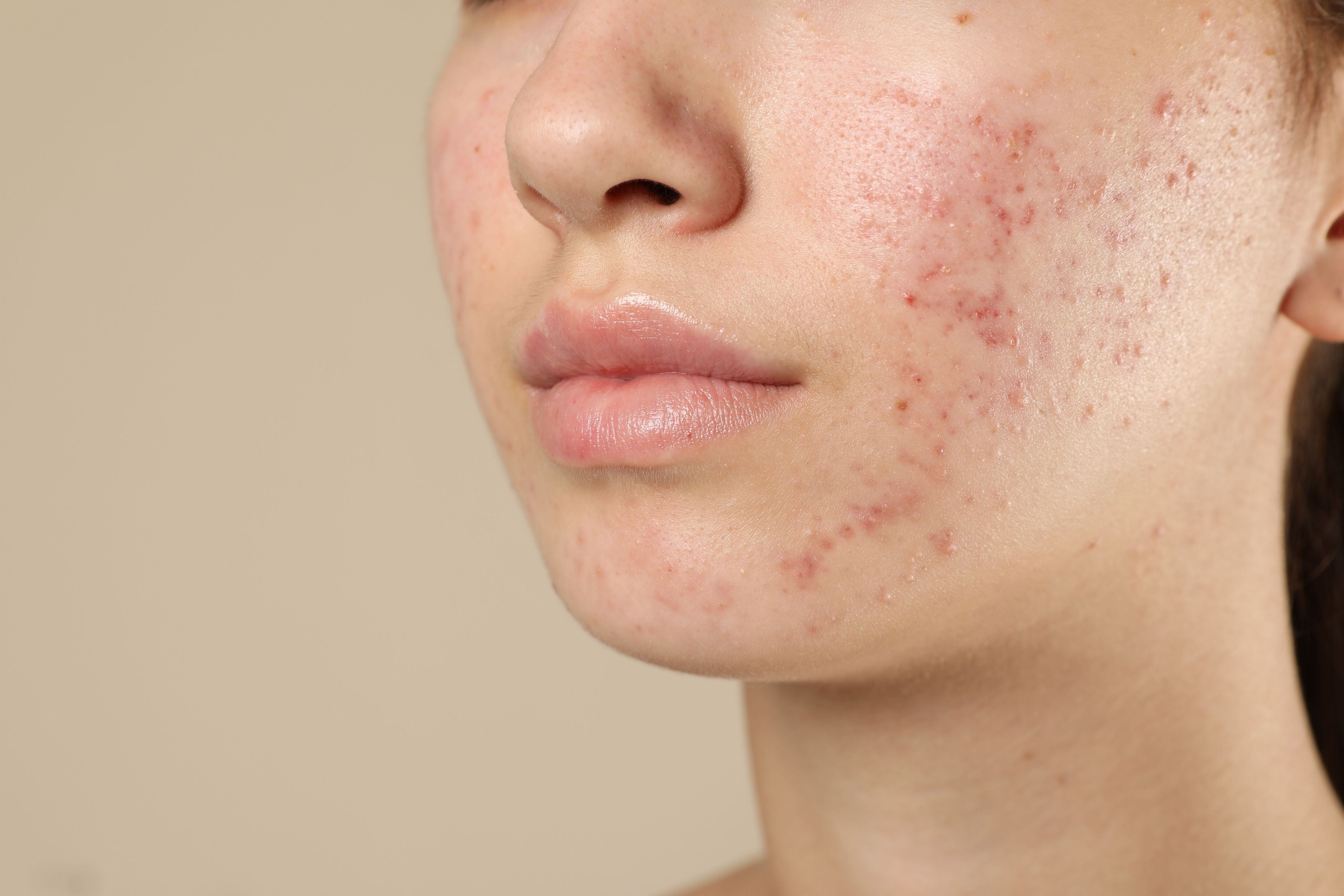Acne & Blemishes